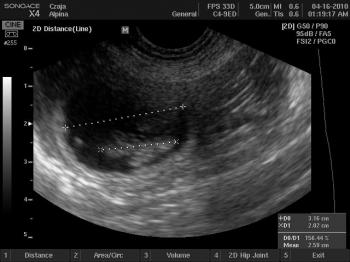 Pierwsze zdjęcie USG maluchów które maja się urodzić w połowie maja 2010!!! Zdjęcie zrobione ok 4 tygodnia ciąży.