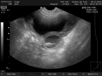 29 dzień ciąży..... Poniżej przedstawiamy zdjęcie jednego z maluchów, które dziś mieliśmy okazje obserwować na ekranie USG....:)